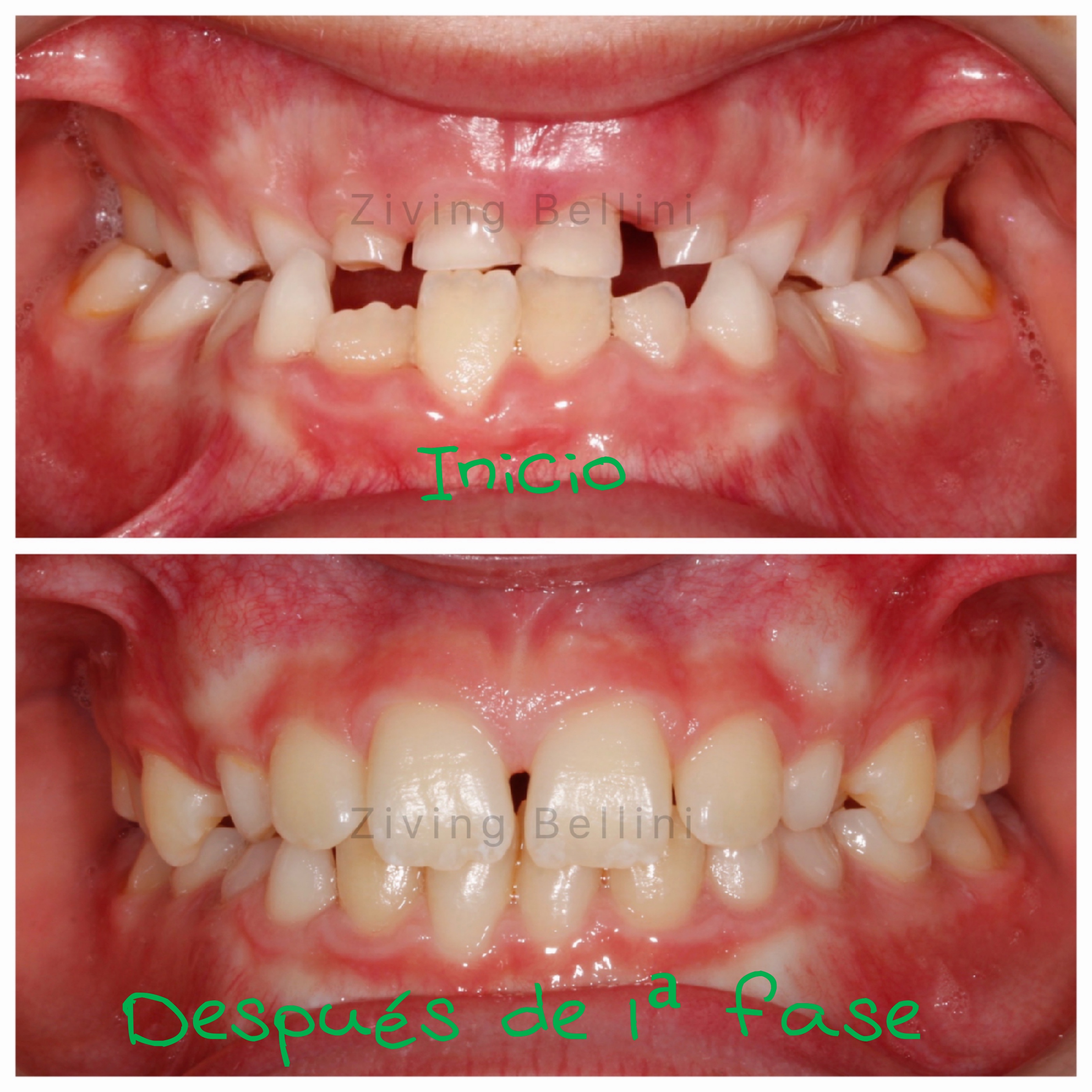 Tratamiento de Ortodoncia Las palmas 1ªFase Ziving Bellini